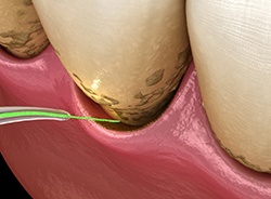 Illustration of laser perio treatment