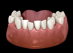 Illustration of crooked teeth
