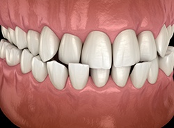 Illustration of a crossbite