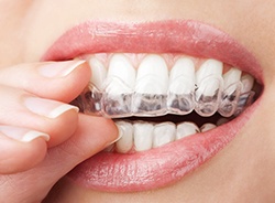 Different types of teeth whitening will affect the total price of treatment