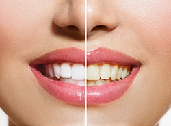 The speed at which you choose to whiten your teeth can also be a factor in the cost of your treatment