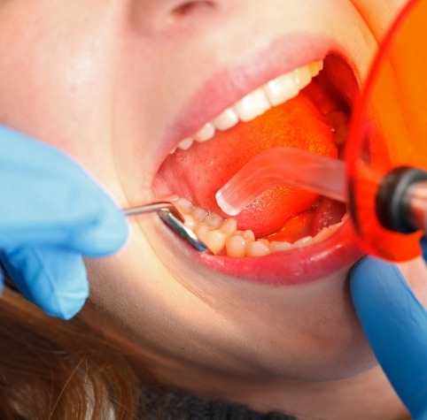 Opalescence Teeth Whitening Hoover, AL, Cosmetic Dentist