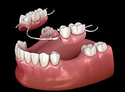 Digital illustration of an implant denture