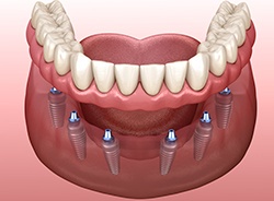 Digital illustration of implant dentures