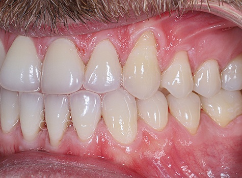 Image of gum recession